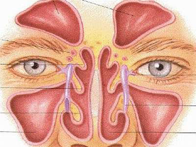 Thủng vách ngăn mũi - Hình ảnh minh họa